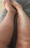 Sand flea bite marks on leg
