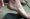 Flesh-eating bacteria on man's heel